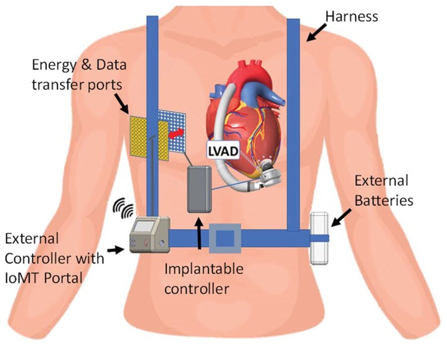 Diagram of an ultrasonic transcutaneous energy and data transfer system powering a left-ventricular assist device